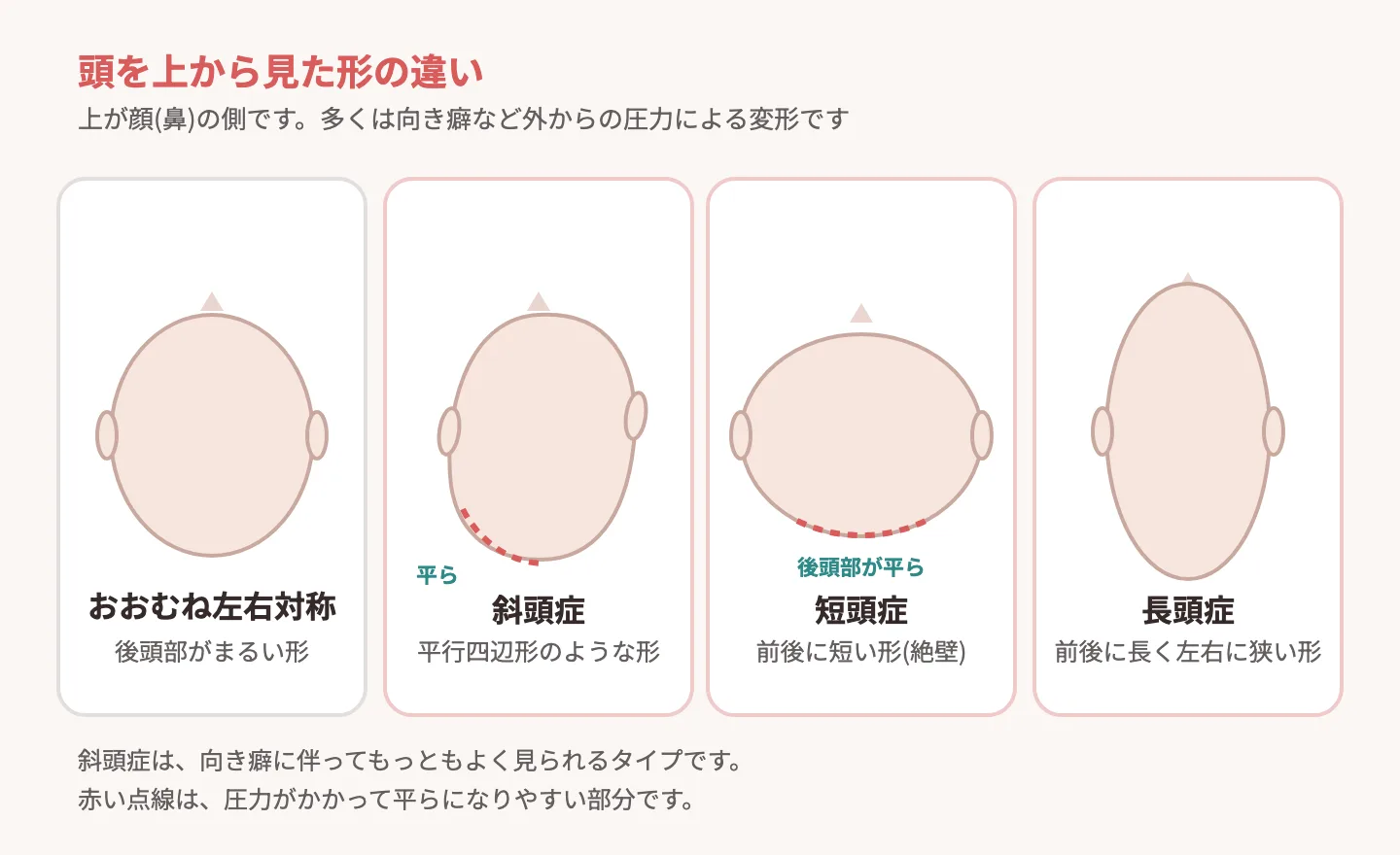 赤ちゃんの頭のゆがみのタイプ(斜頭症・短頭症)を示す図解