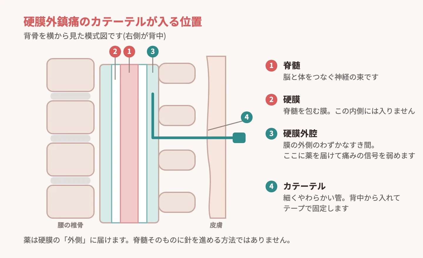 硬膜外麻酔で背中からカテーテルを入れる位置を示す図解